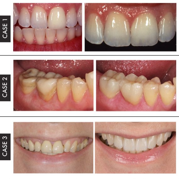 Authentic Dental Laboratory | Restorations