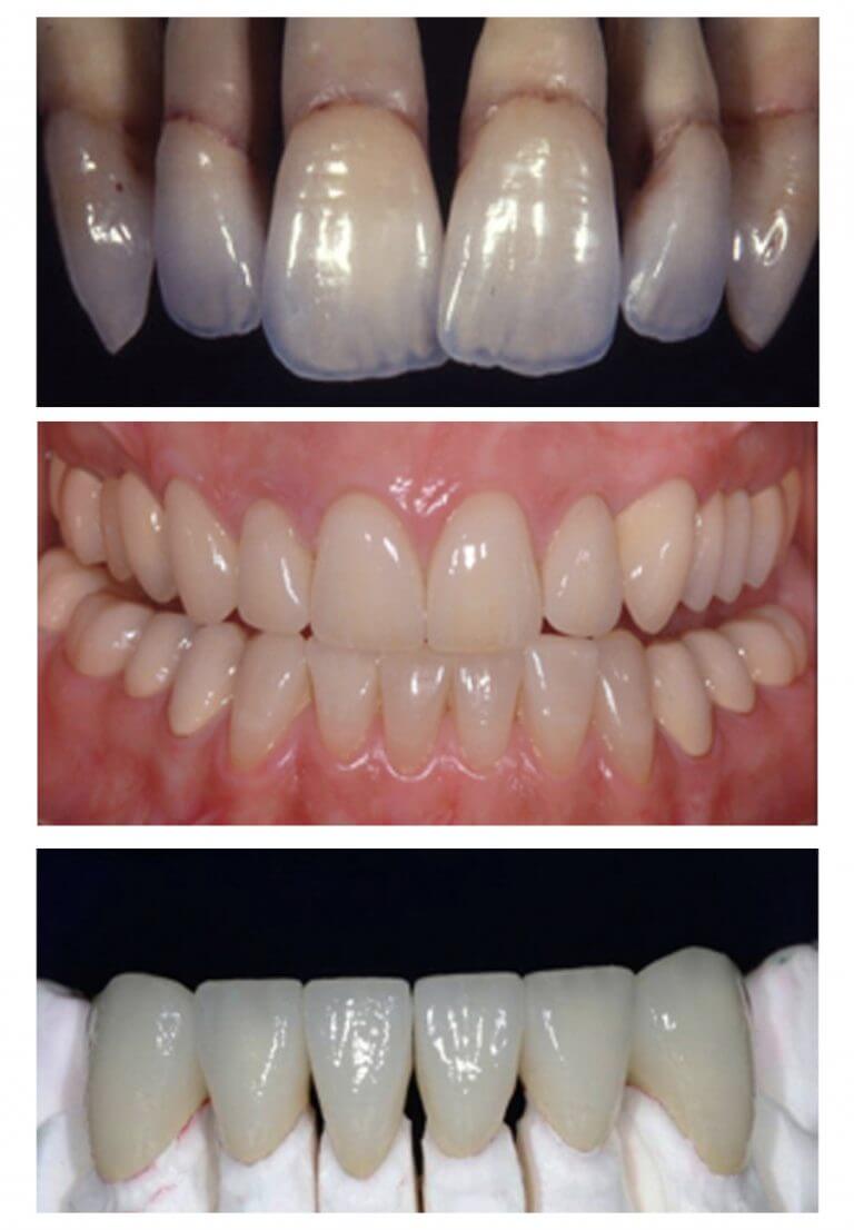 Authentic Dental Laboratory Restorations